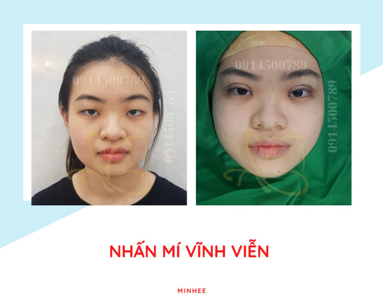 Nhan Mi Vinh Vien