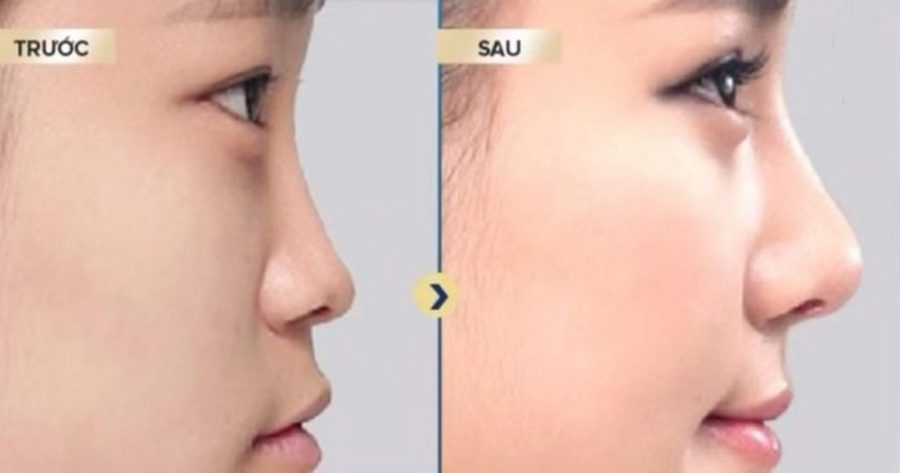 Tiem Filter Nang Mui