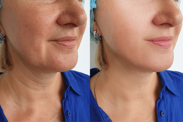 điều Trị Da Chemical Peel Before After