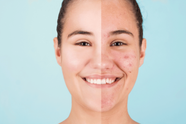 điều Trị Nám Tàn Nhang đồi Mồi Tại Kanin Beauty 2