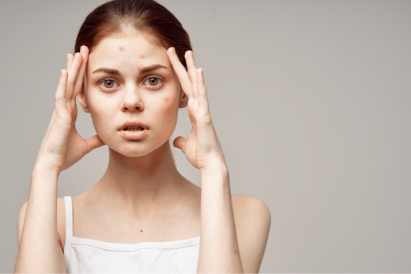 Quy Trình điều Trị Mụn Tại Kanin Beauty